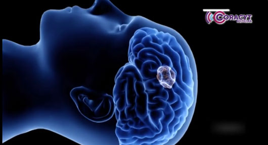 Anualmente se detectan 7.5 casos de tumores cerebrales