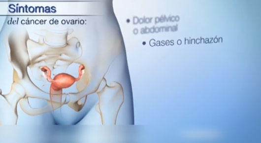 Recomiendan revisiones periódicas para la detección temprana del cáncer de ovario